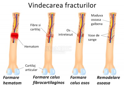 tratamentul fracturilor osoase la cot